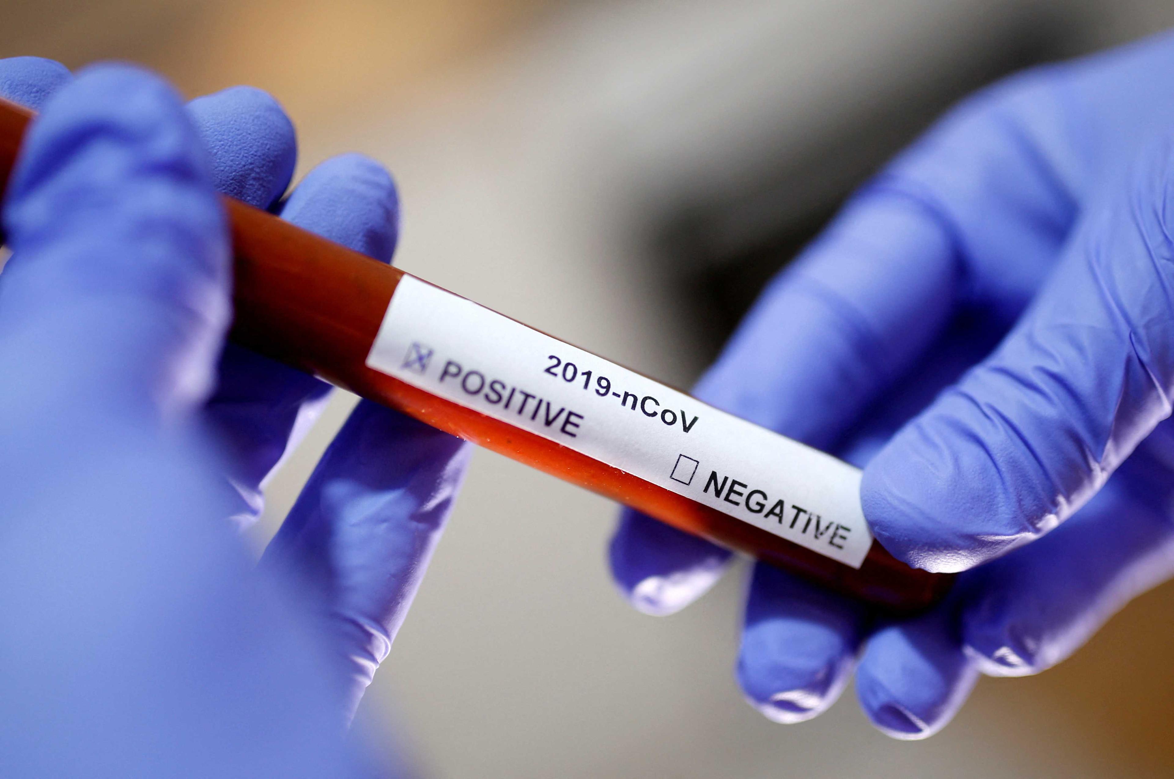 Gambar fail tabung uji sampel darah seorang pesakit Coivid-19 yang diambil pada 29 Januari 2020. Gambar: Reuters