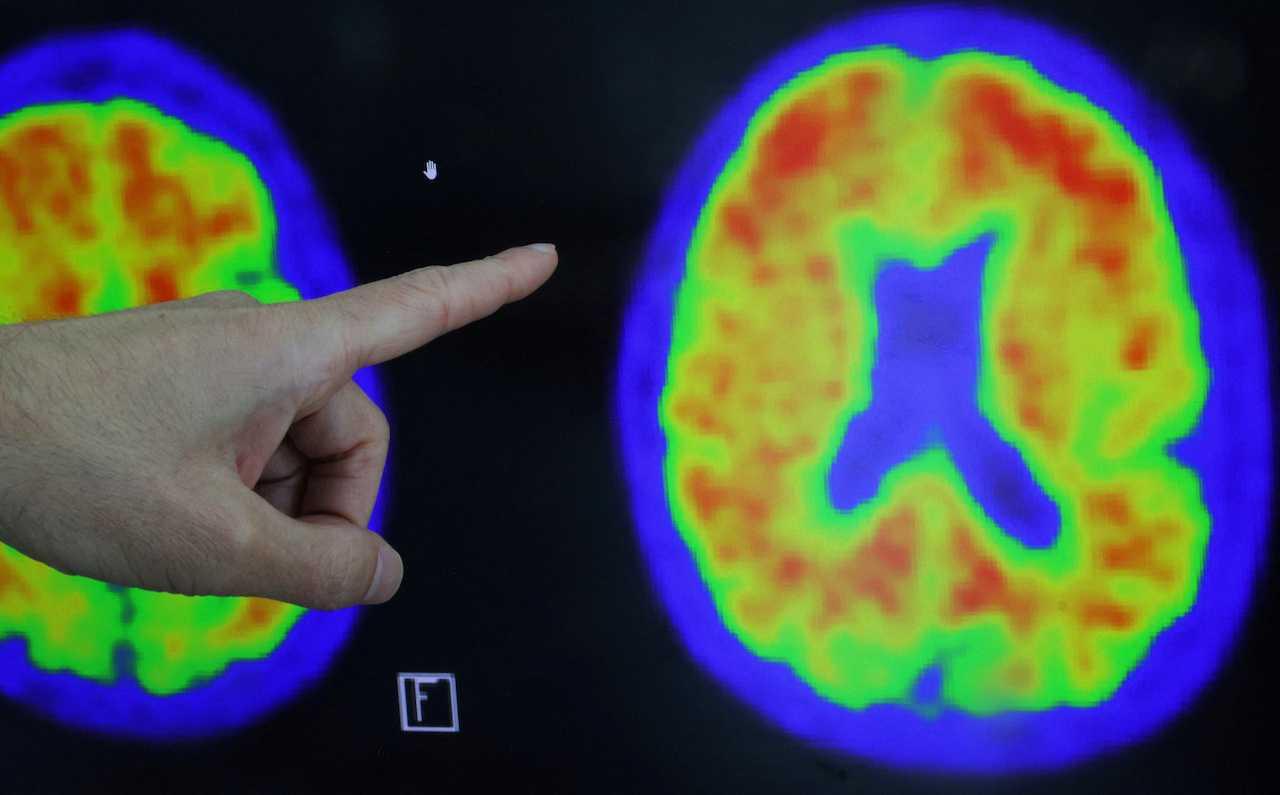 A doctor points out evidence of Alzheimer’s disease on PET scans at the Center for Alzheimer Research and Treatment at Brigham And Women’s Hospital in Boston, Massachusetts, March 30. Photo: Reuters