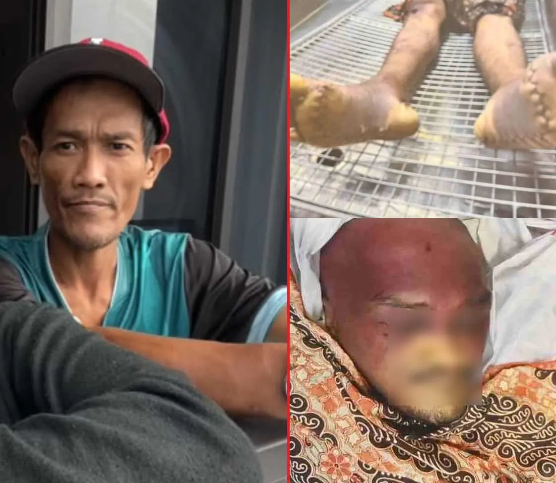 Gambar Noorizwan Zulkefly sebelum ditangkap polis (kiri), serta gambar menunjukkan kesan lebam teruk pada kepala dan kakinya, yang disimpulkan pakar patologi forensik adalah berpunca daripada pukulan teruk.