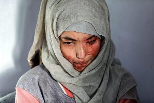 After being hospitalised in a clinic where she had once been employed, Al-Anoud Hussain Sheryan is now waiting to undergo the three plastic surgery operations needed to repair some of the damage. Photo: AFP