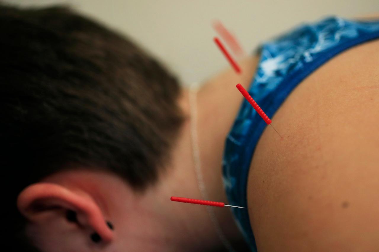 Some swear by alternative remedies for their ailments, such as acupuncture, but others have tried them with no luck. Photo: AP