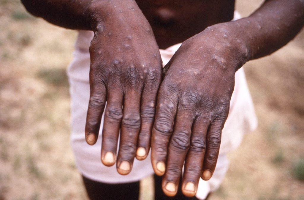 This handout photo provided by the Centers for Disease Control and Prevention, taken in 1997 during an investigation into an outbreak of monkeypox in the Democratic Republic of the Congo, depicts the dorsal surfaces of a monkeypox case in a patient who was displaying the appearance of the characteristic rash during its recuperative stage. Photo: AFP/CDC